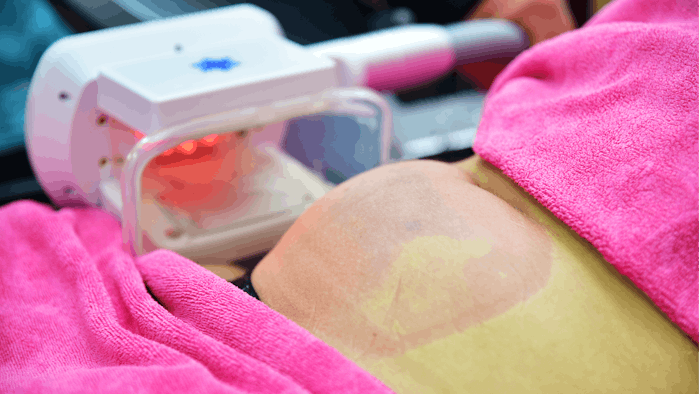 Researchers uncover mechanism by which cryolipolysis tightens skin.