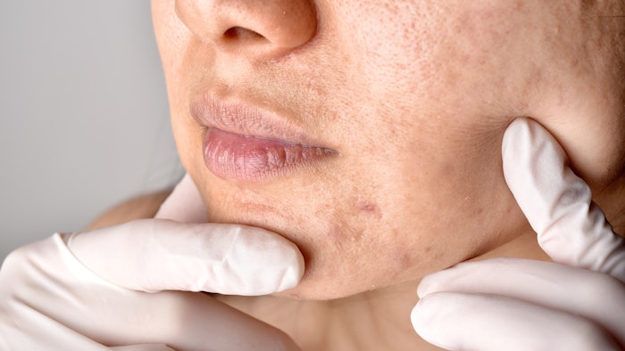 woman with acne scars