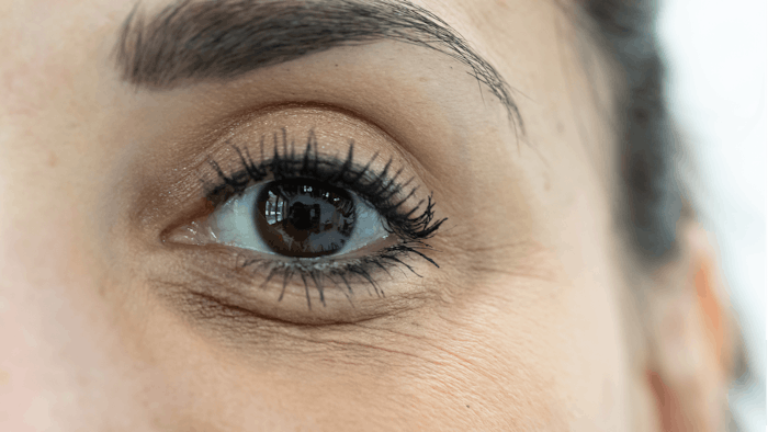 Hyaluronic Acid Injections for Undereye Circles