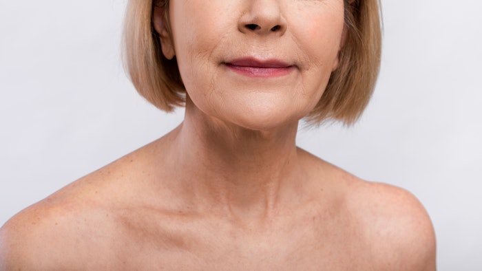 Immediate injection of PLLA after reconstiution is safe and effective for nasolabial folds.