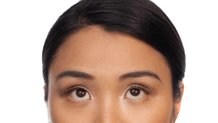 Botulinum toxin injections (BTX) performed immediately after wound closure significantly reduced the width of lower blepharoplasty scars.