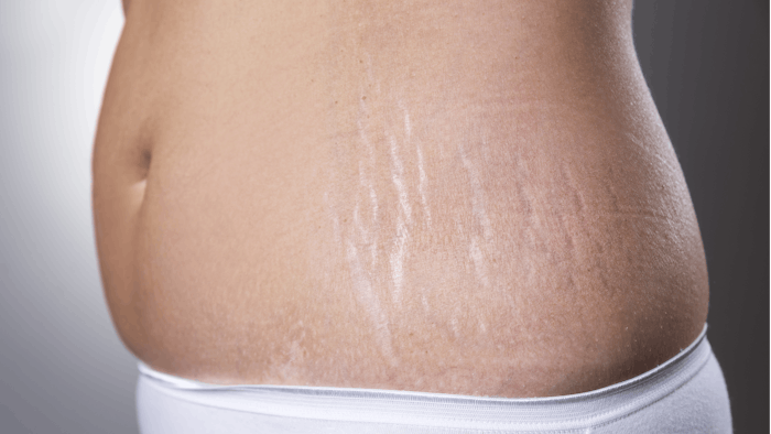 Comparison of CO2 laser or carboxytherapy for stretch marks.