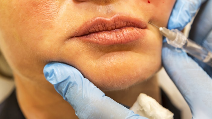 Three injections of autologous fibroblasts increased total skin density at six month follow-up.