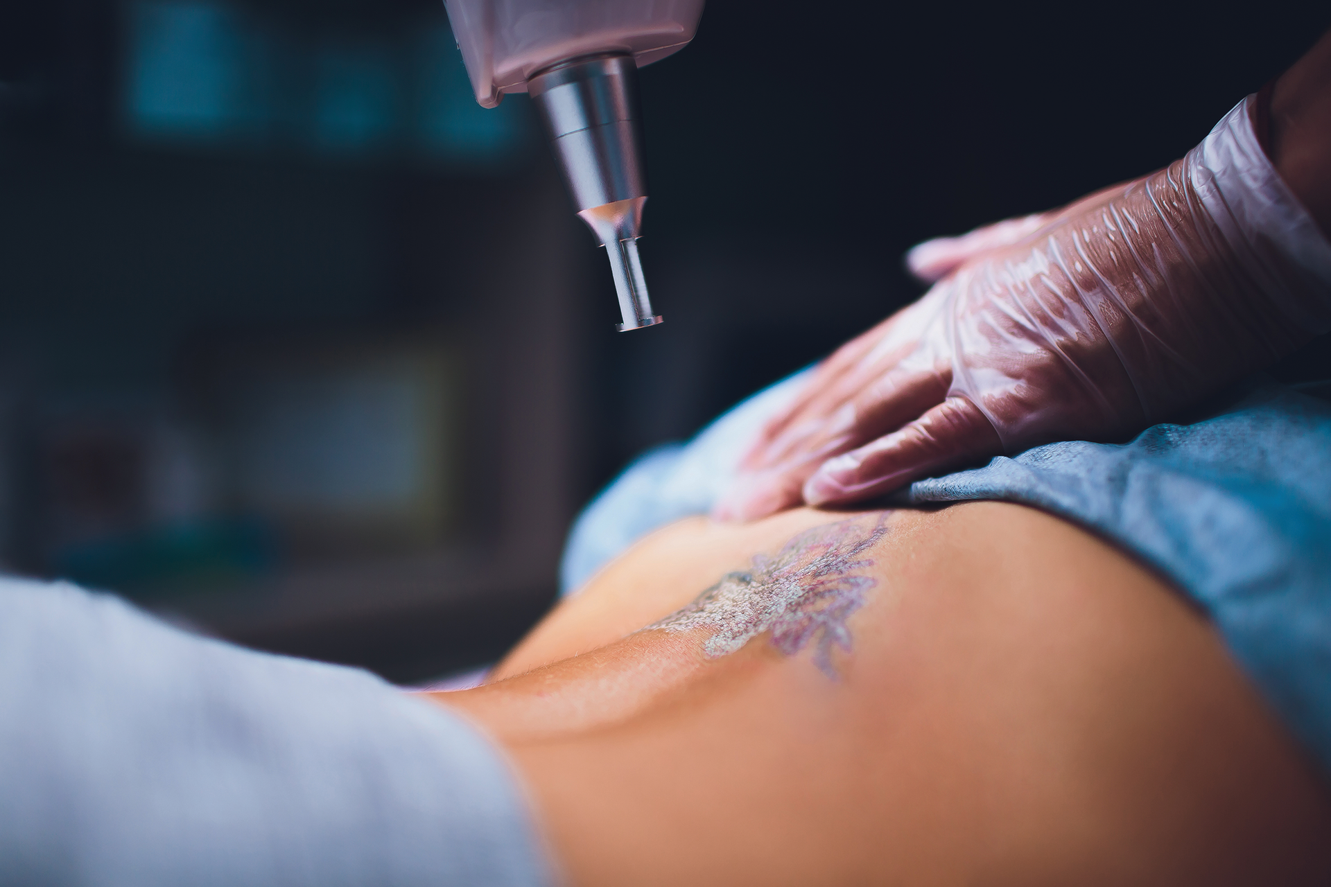 laser tatoo removal treatment at our dermatologists office in Virginia Beach  treating laser tatoo removal