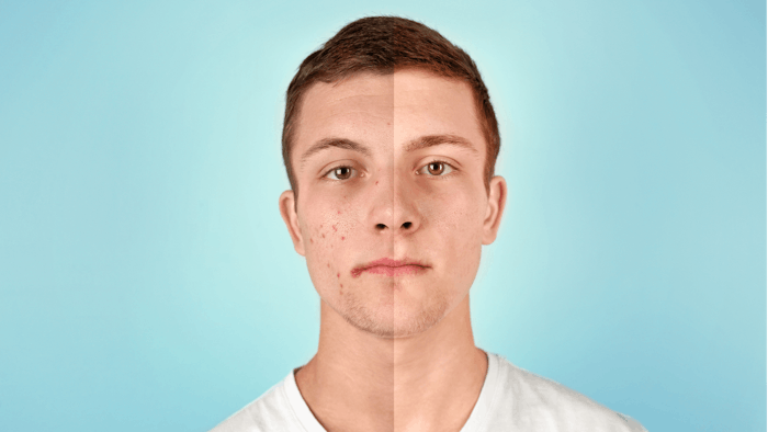 Niacinamide Enhances Efficacy of Benzoyl Peroxide for Acne.