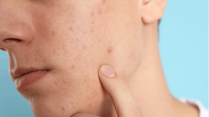 Nano lipid carrier delivery enhanced the efficacy of tretinoin for acne.