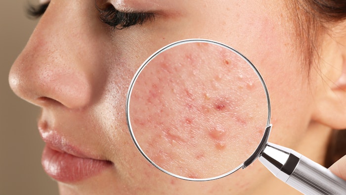 girl with acne