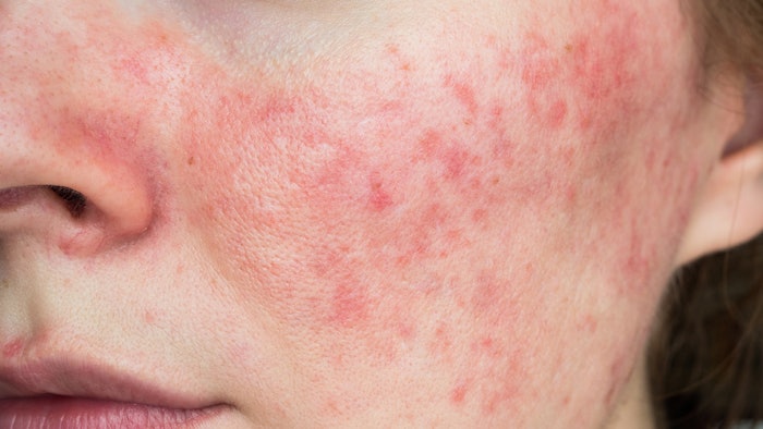 Non-insulated fractional microneedle radiofrequency provided visible improvement for patients with difficult-to-treat rosacea.