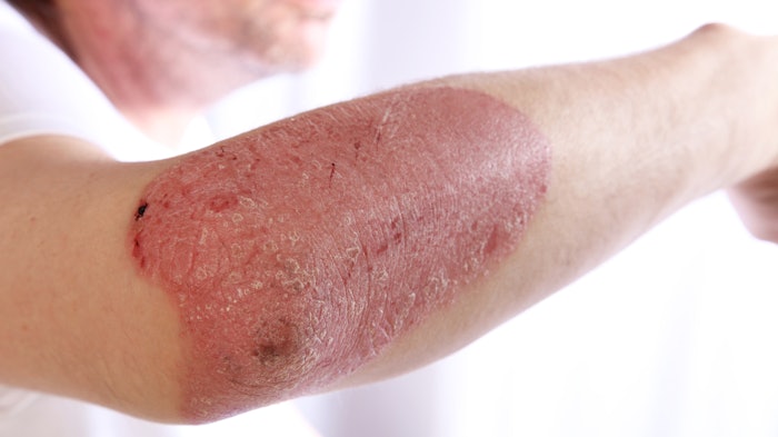 Woman with plaque psoriasis on her arm