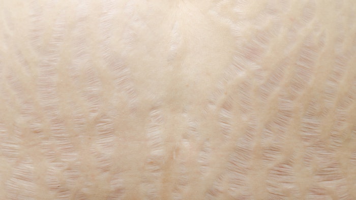 Fractional Er:YAG vs. fractional RF for stretch marks.