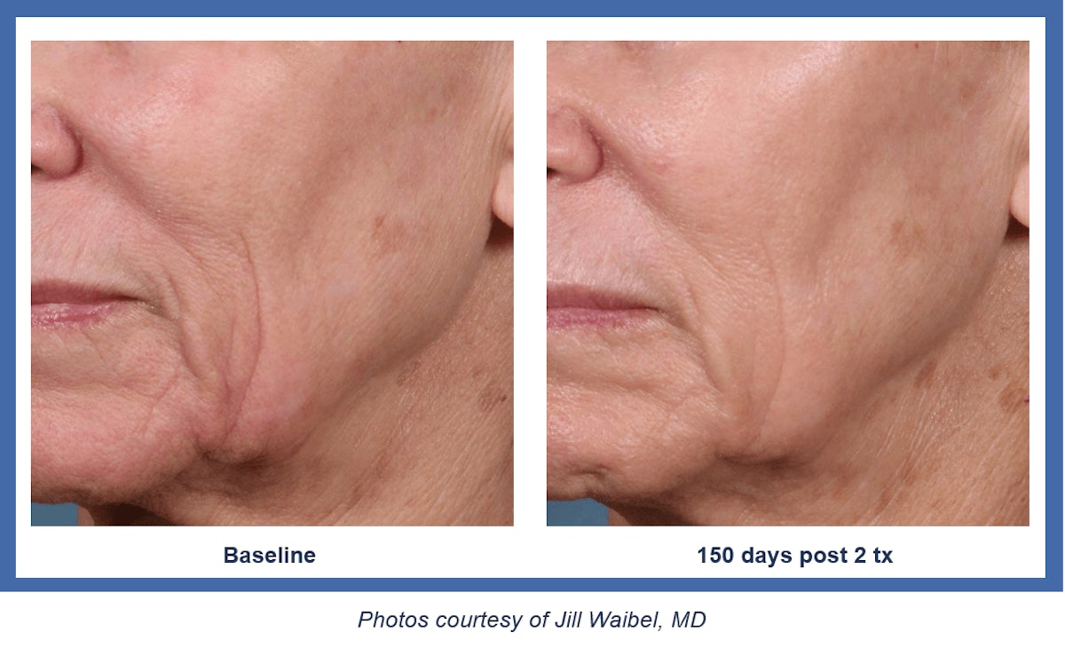 FDA Clears ellacor MicroCoring Technology for Wrinkles MedEsthetics