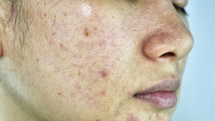 The NMPA has approved the Phase II clinical trial application of ASC40 for the treatment of acne.