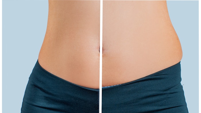 The study revealed higher than expected rates of paradoxical hyperplasia following cryolipolysis treatment.