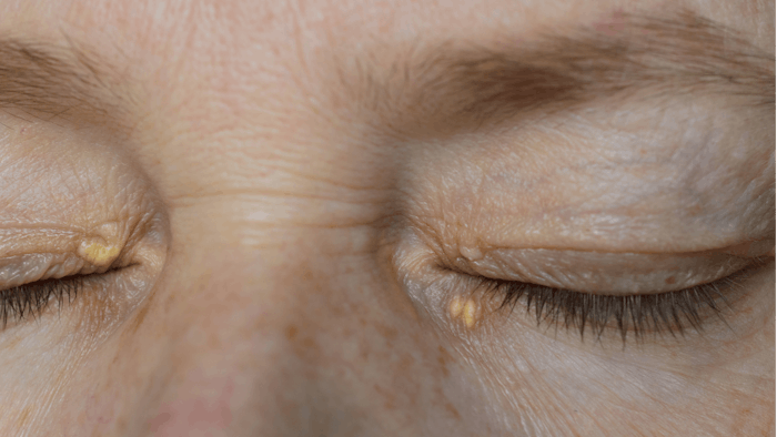 Patient with xanthelasma on eyelids.