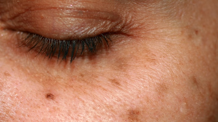 Researchers used cryotherapy to selectively target melanocytes in the skin.