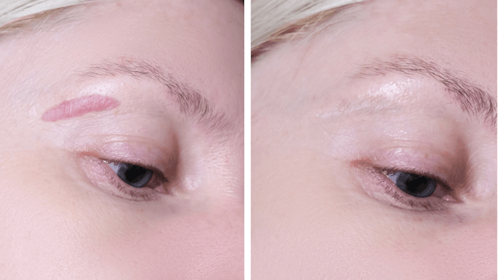 PDL reduces vascularity and thickness of early stage hypertrophic scars.