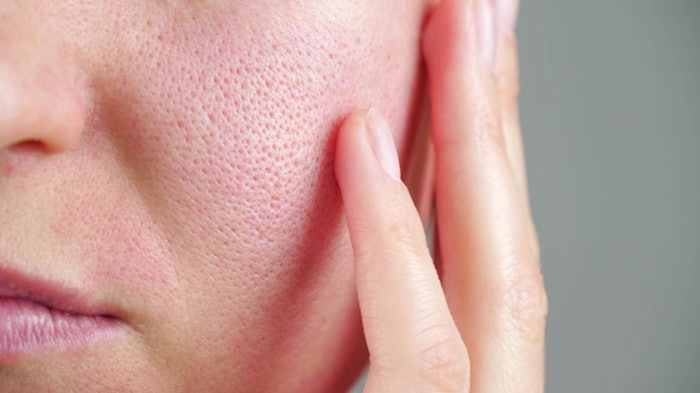 MFU-V used alone and in combination with HA filler reduced pore size.