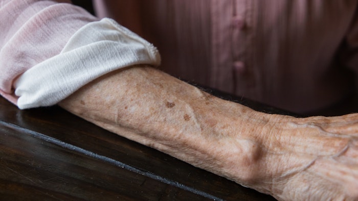 arm spotted with senile purpura