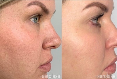 Aerolase Me2109 Ba1 Ashley