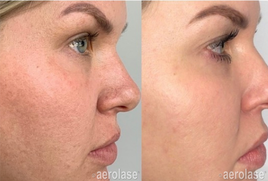 Aerolase Me2109 Ba1 Ashley