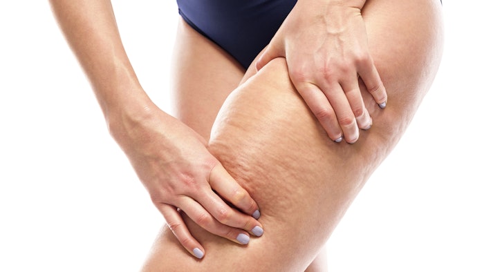 Woman with cellulite on her leg