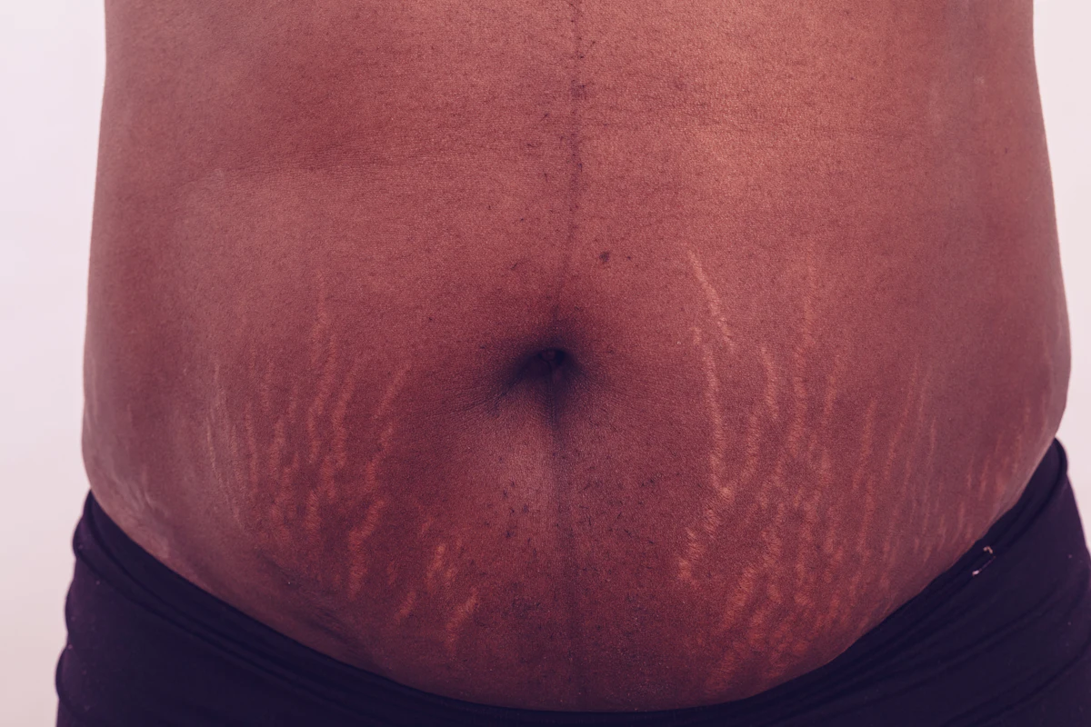 Stria Rash Safe and Effective Treatment for Striae Alba in Skin of Color ...