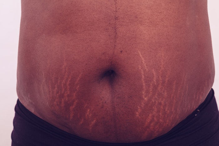 Woman with stretch marks