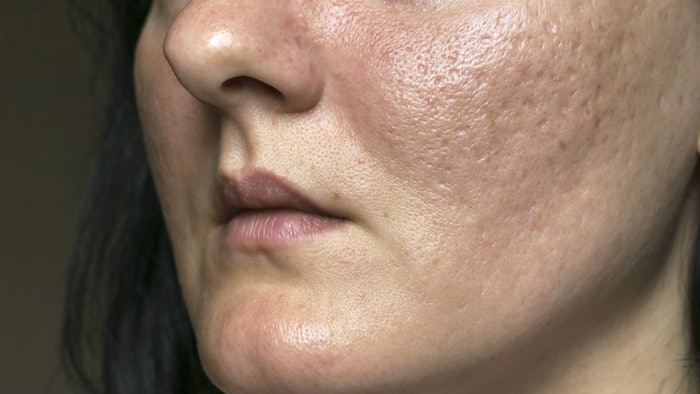 Woman with acne scars
