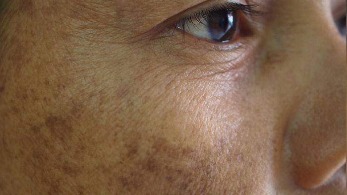 Woman with dark spots
