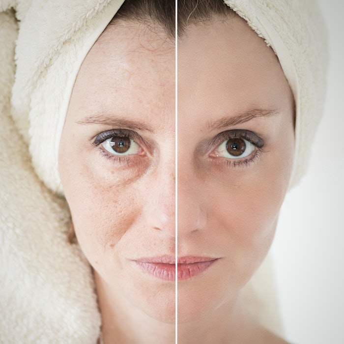 Researchers have developed a device that measures skin glycation.