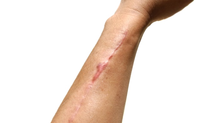 Hypertrophic scar on arm