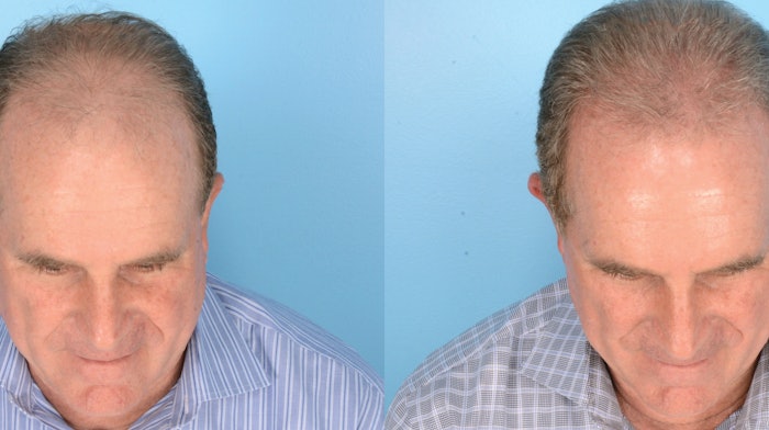 PDO thread technique for hair restoration