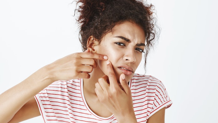 Woman popping pimple