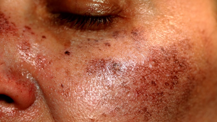 Woman with melasma