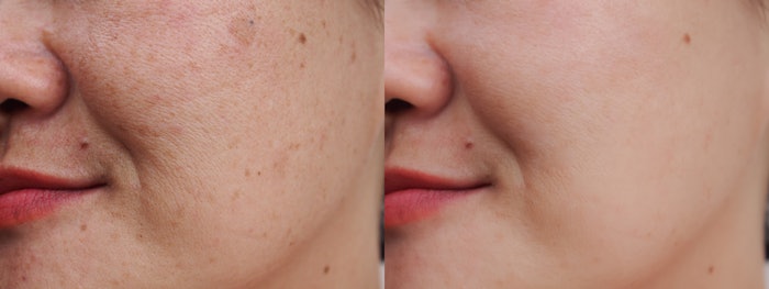 Before and After Melasma Treatment
