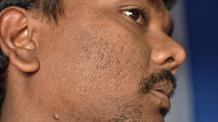 High-energy ablative fractional nanosecond Q-switched 1,064 nm laser therapy for acne scars.