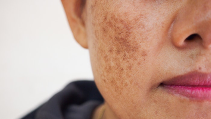 Er:YAG laser-assisted deliver of kojic acid is effective in the treatment of melasma.