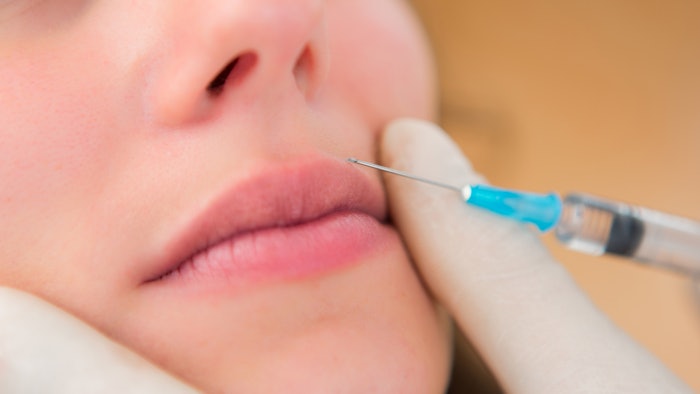 One session of PRF injections noticeably rejuvenated the lip area.
