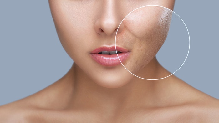 before and after acne treatment