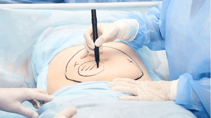 Sono Bello is offering six-week fellowships for surgeons seeking training in liposuction and skin excision procedures.