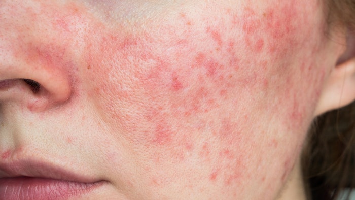 Funded by donations from rosacea sufferers, the NRS research grants program has awarded more than $1.6 million, to date.