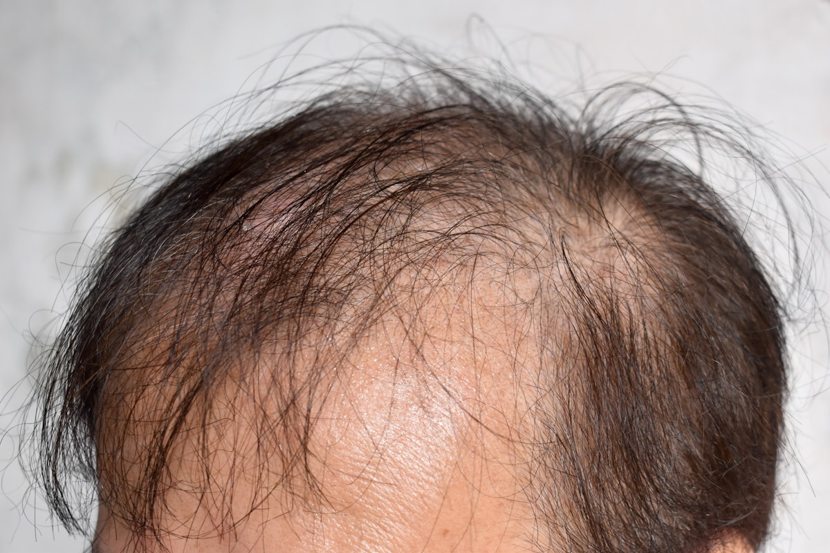 LLLT Improves Efficacy of Minoxidil for Androgenic Alopecia | MedEsthetics