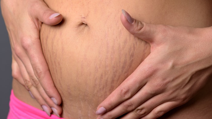 Woman with stretch marks