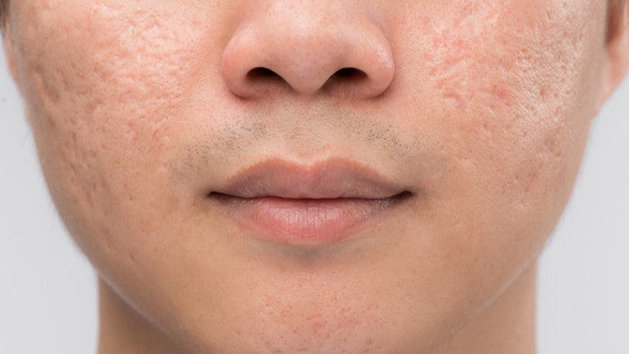 Man with acne scars
