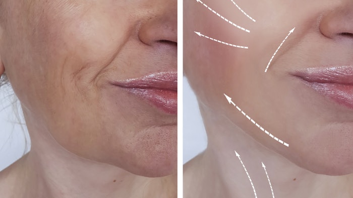 Woman getting treatment for photoaging
