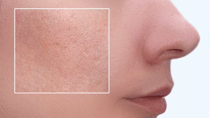Treatment with a 755 nm picosecond alexandrite laser reduced pore size at all time points up to four week follow-up.