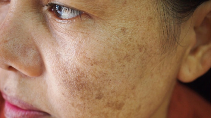The addition of low power fractional CO2 did reduce rates of postprocedure punctate leukoderma.