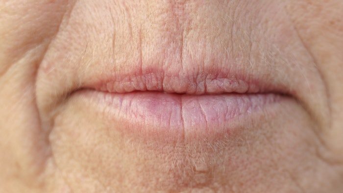 The Resilient Hyaluronic Acid (RHA) filler significantly improved perioral rhytids for up to 52 weeks.