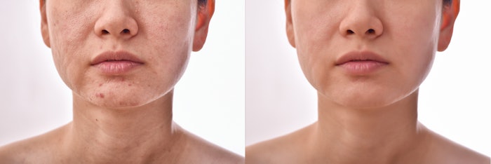 Ascletis announces dosing of first patient in phase II acne clinical trial. (Stock image; results not achieved through trial medication.)
