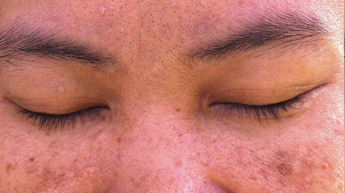 woman with melasma